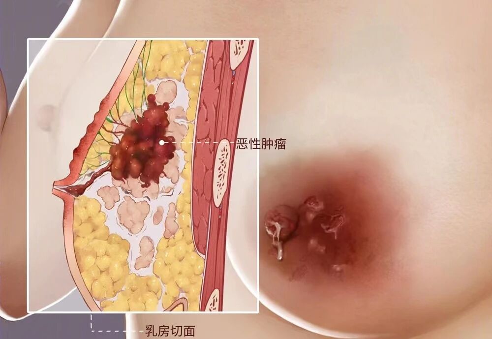摸到疙瘩确诊乳腺癌摸到疙瘩并不一定意味着确诊乳腺癌。虽然乳腺癌可能会在乳房部位形成肿块或疙瘩，但这并不是唯一的诊断依据。
